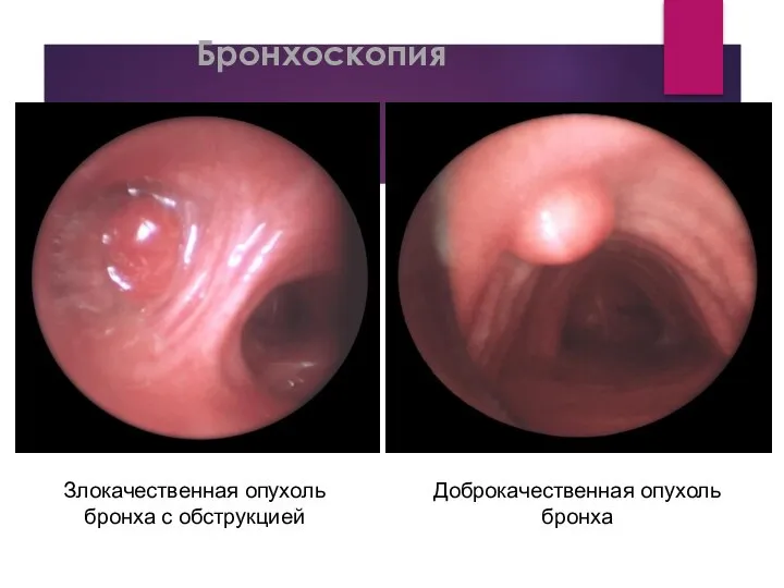 Бронхоскопия Злокачественная опухоль бронха с обструкцией Доброкачественная опухоль бронха