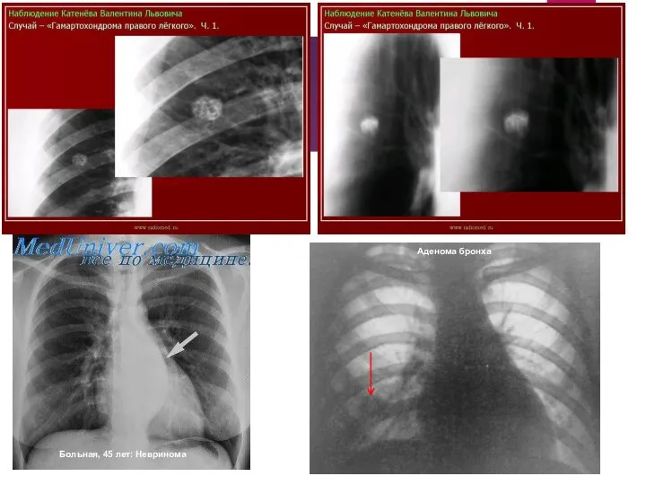 Больная, 45 лет: Невринома Аденома бронха