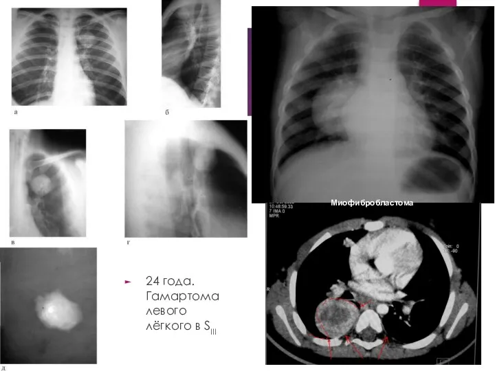 24 года. Гамартома левого лёгкого в SIII Миофибробластома