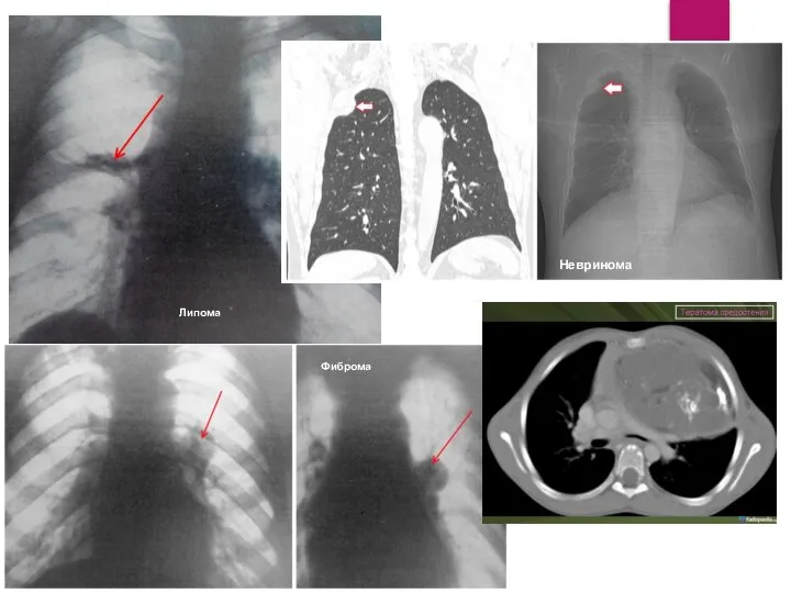 Липома Фиброма Невринома