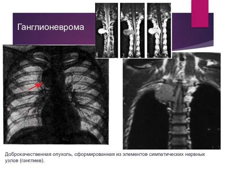 Ганглионеврома Доброкачественная опухоль, сформированная из элементов симпатических нервных узлов (ганглиев).