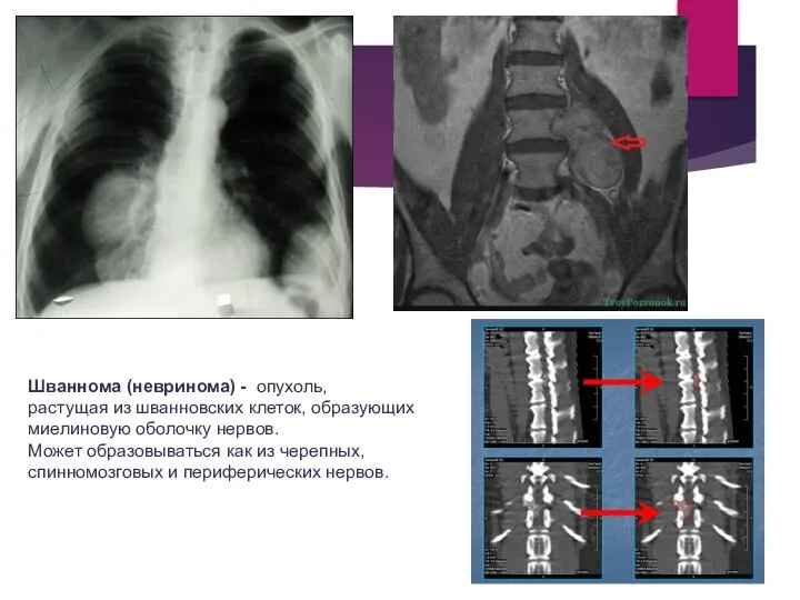 Шваннома (невринома) - опухоль, растущая из шванновских клеток, образующих миелиновую оболочку