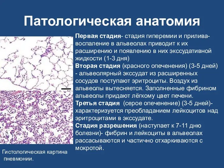 Патологическая анатомия Гистологическая картина пневмонии. Первая стадия- стадия гиперемии и прилива-