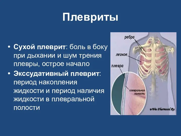 Плевриты Сухой плеврит: боль в боку при дыхании и шум трения