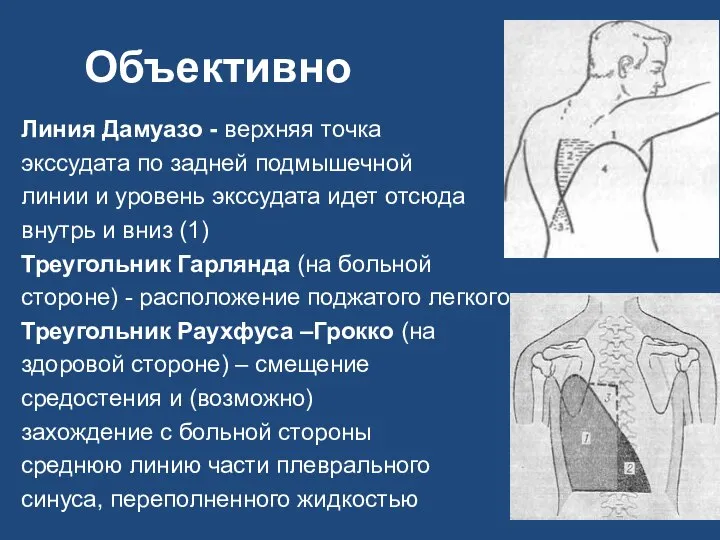 Объективно Линия Дамуазо - верхняя точка экссудата по задней подмышечной линии