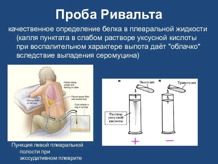 Проба Ривальта качественное определение белка в плевральной жидкости (капля пунктата в