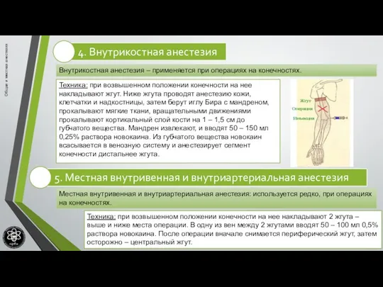 Общая и местная анестезия Внутрикостная анестезия – применяется при операциях на