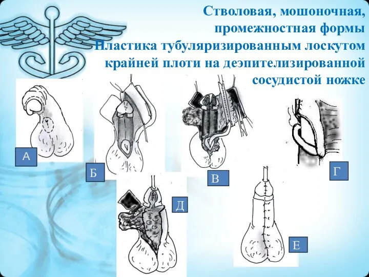 А Г Б В Д Е Стволовая, мошоночная, промежностная формы Пластика