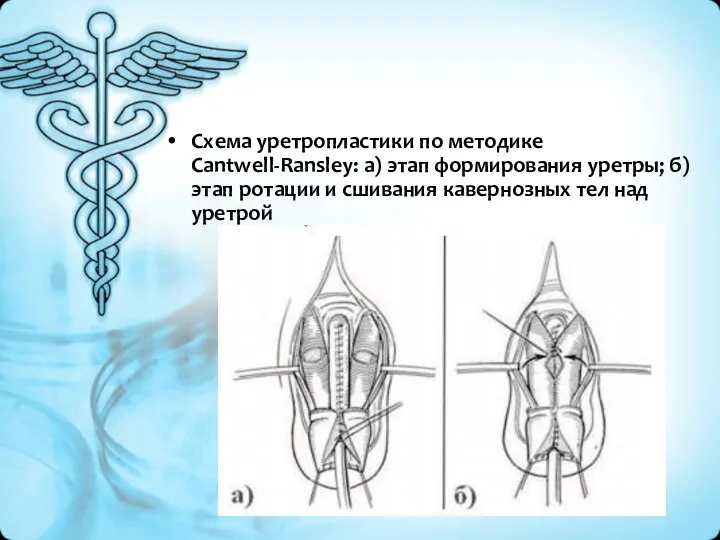 Схема уретропластики по методике Cantwell-Ransley: а) этап формирования уретры; б) этап