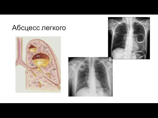 Абсцесс легкого