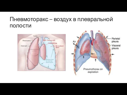 Пневмоторакс – воздух в плевральной полости