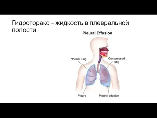 Гидроторакс – жидкость в плевральной полости