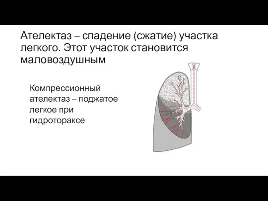 Ателектаз – спадение (сжатие) участка легкого. Этот участок становится маловоздушным Компрессионный