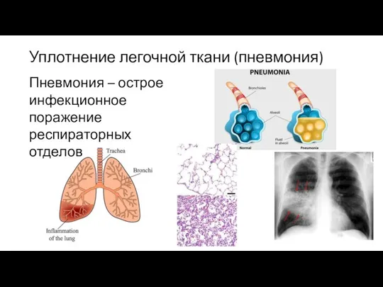 Уплотнение легочной ткани (пневмония) Пневмония – острое инфекционное поражение респираторных отделов