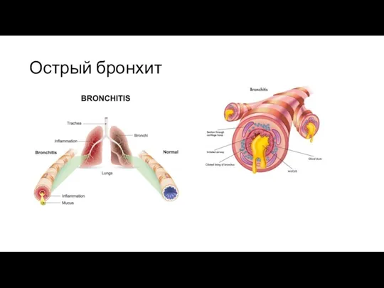 Острый бронхит