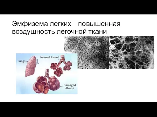 Эмфизема легких – повышенная воздушность легочной ткани