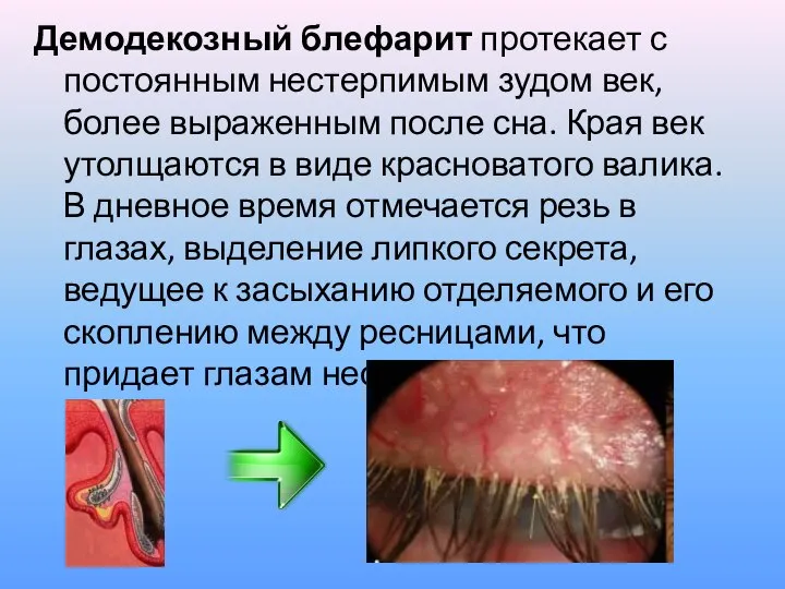 Демодекозный блефарит протекает с постоянным нестерпимым зудом век, более выраженным после