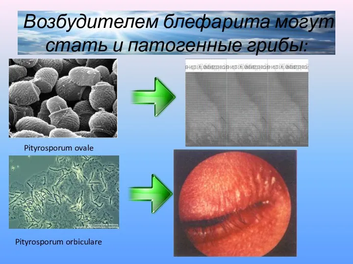 Возбудителем блефарита могут стать и патогенные грибы: Pityrosporum ovale Pityrosporum orbiculare