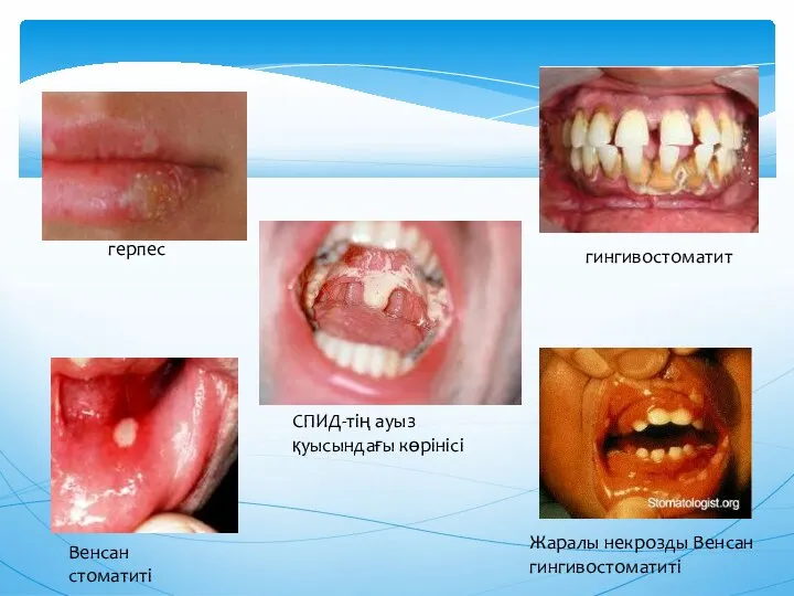 гингивостоматит Венсан стоматиті герпес Жаралы некрозды Венсан гингивостоматиті СПИД-тің ауыз қуысындағы көрінісі