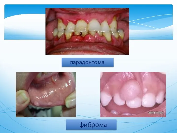 парадонтома фиброма