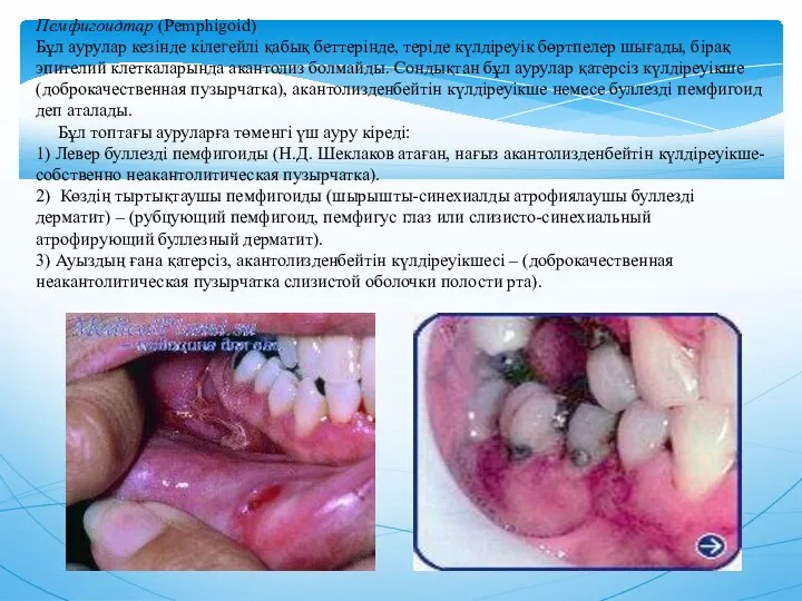 Пемфигоидтар (Pemphigoid) Бұл аурулар кезiнде кiлегейлi қабық беттерiнде, терiде күлдiреуiк бөртпелер