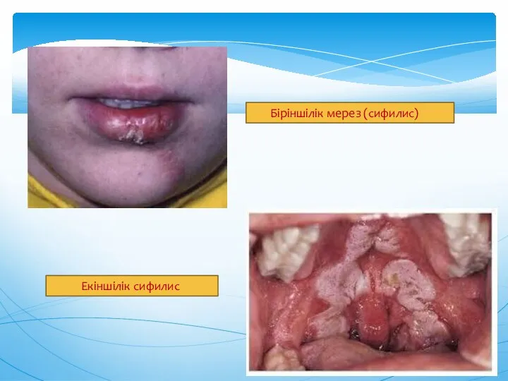 Біріншілік мерез (сифилис) Екіншілік сифилис