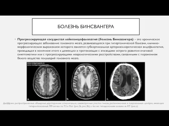 БОЛЕЗНЬ БИНСВАНГЕРА Прогрессирующая сосудистая лейкоэнцефалопатия (болезнь Бинсвангера) – это хроническое прогрессирующее