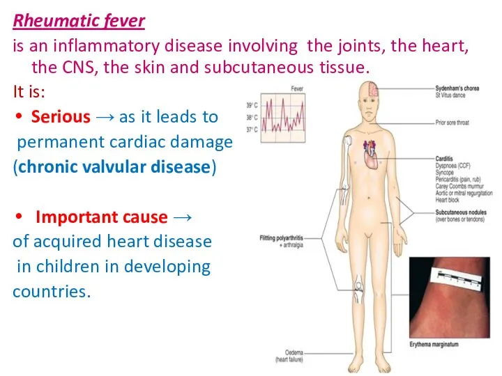 Rheumatic fever is an inflammatory disease involving the joints, the heart,