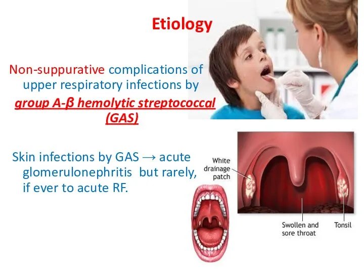 Etiology Non-suppurative complications of upper respiratory infections by group A-β hemolytic