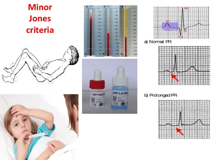 Minor Jones criteria