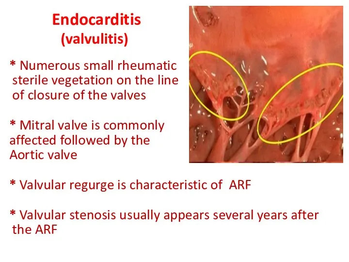 Endocarditis (valvulitis) * Numerous small rheumatic sterile vegetation on the line