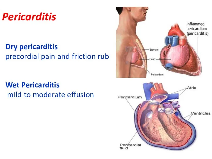 Pericarditis Dry pericarditis precordial pain and friction rub Wet Pericarditis mild to moderate effusion