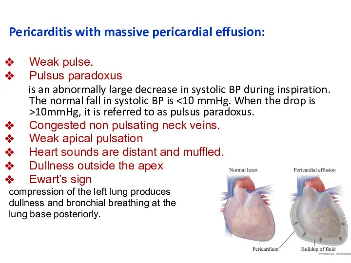 Pericarditis with massive pericardial effusion: Weak pulse. Pulsus paradoxus is an