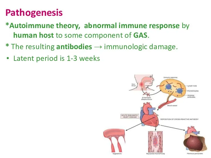Pathogenesis *Autoimmune theory, abnormal immune response by human host to some