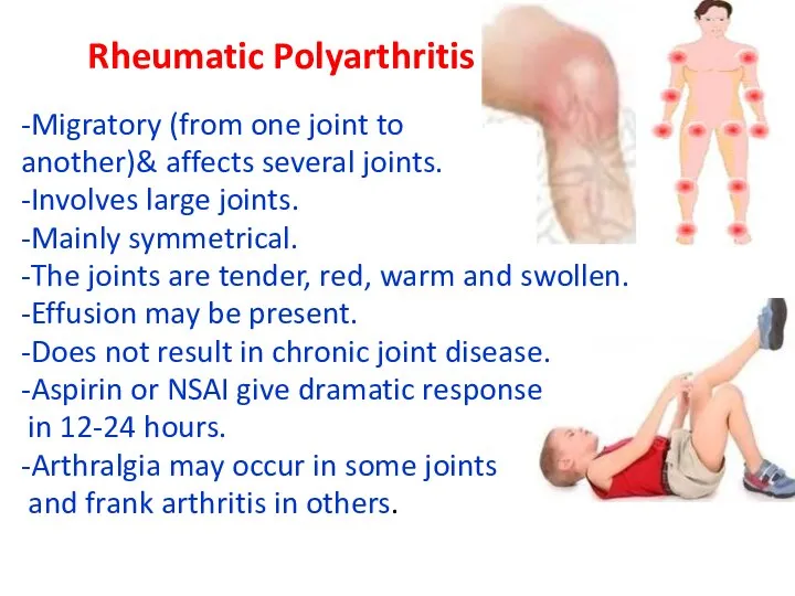 Rheumatic Polyarthritis -Migratory (from one joint to another)& affects several joints.