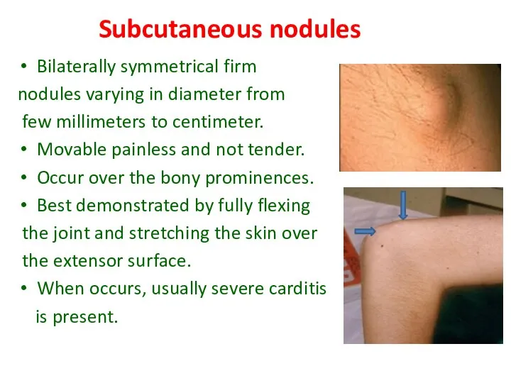 Subcutaneous nodules Bilaterally symmetrical firm nodules varying in diameter from few