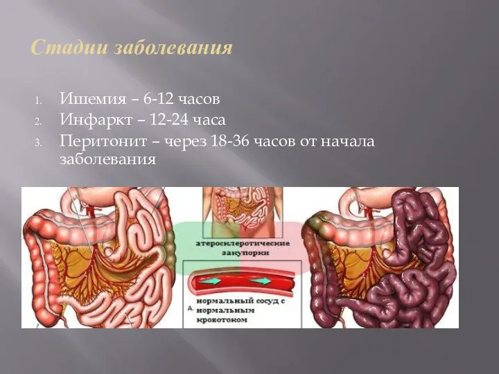 Стадии заболевания Ишемия – 6-12 часов Инфаркт – 12-24 часа Перитонит