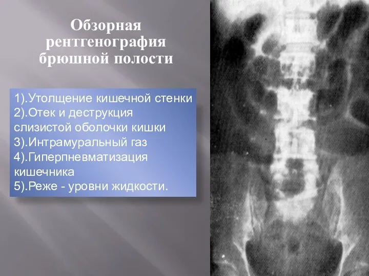 Обзорная рентгенография брюшной полости 1).Утолщение кишечной стенки 2).Отек и деструкция слизистой
