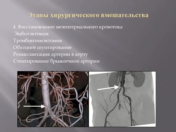 Этапы хирургического вмешательства 4. Восстановление мезентериального кровотока Эмболэктомия Тромбинтимэктомия Обходное шунтирование