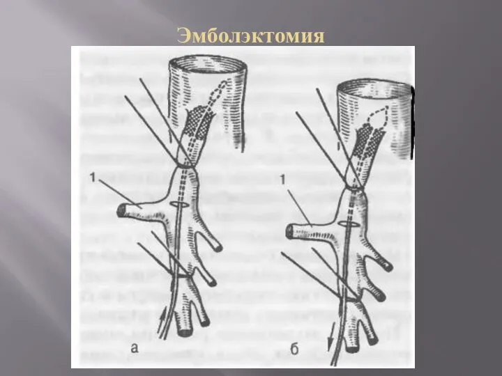 Эмболэктомия