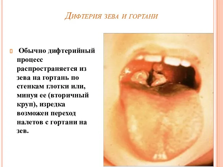 Дифтерия зева и гортани Обычно дифтерийный процесс распространяется из зева на