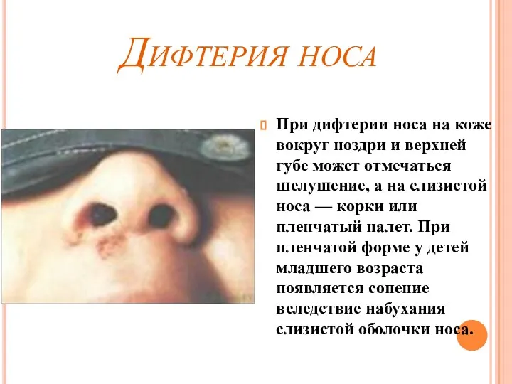 Дифтерия носа При дифтерии носа на коже вокруг ноздри и верхней