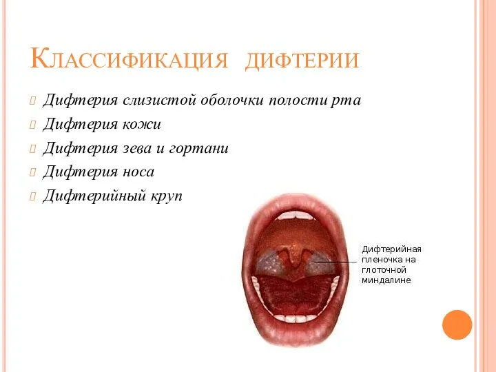 Классификация дифтерии Дифтерия слизистой оболочки полости рта Дифтерия кожи Дифтерия зева