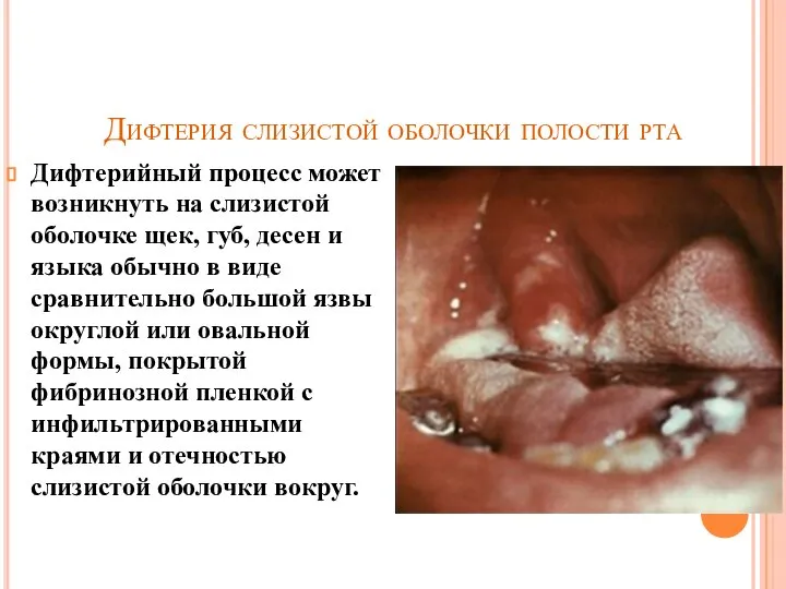 Дифтерия слизистой оболочки полости рта Дифтерийный процесс может возникнуть на слизистой