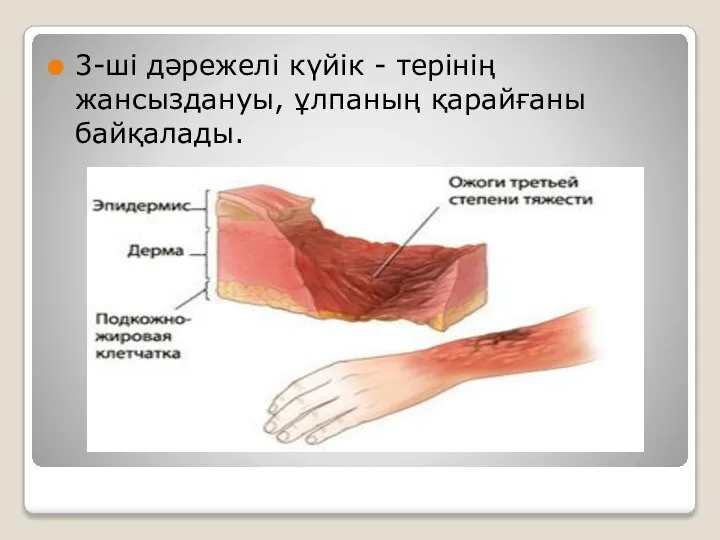 3-ші дәрежелі күйік - терінің жансыздануы, ұлпаның қарайғаны байқалады.