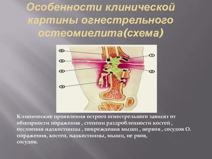 Особенности клинической картины огнестрельного остеомиелита(схема) Клинические проявления острого огнестрельного зависят от