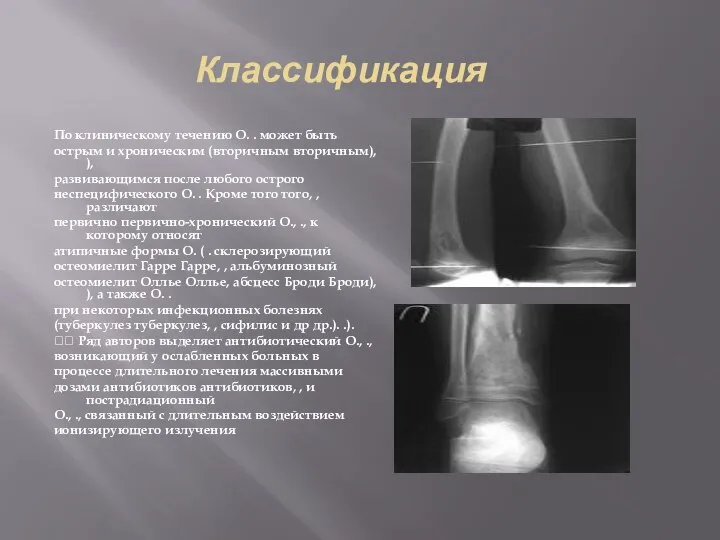 Классификация По клиническому течению О. . может быть острым и хроническим