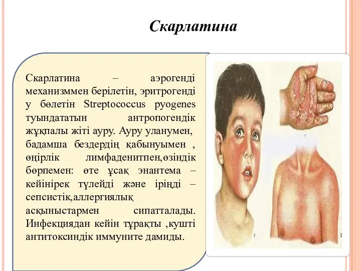 Скарлатина Скарлатина – аэрогенді механизммен берілетін, эритрогенді у бөлетін Streptococcus pyogenes