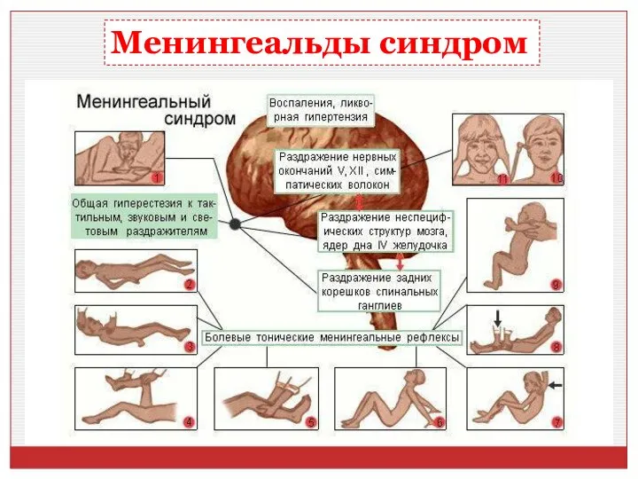 Менингеальды синдром