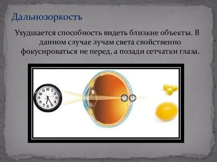 Ухудшается способность видеть близкие объекты. В данном случае лучам света свойственно